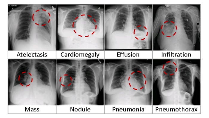 chest x-ray examples